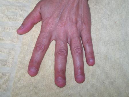 Ongles rongés